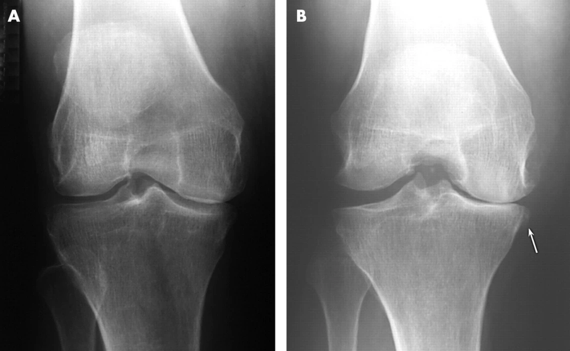 2 knee x-rays side by side