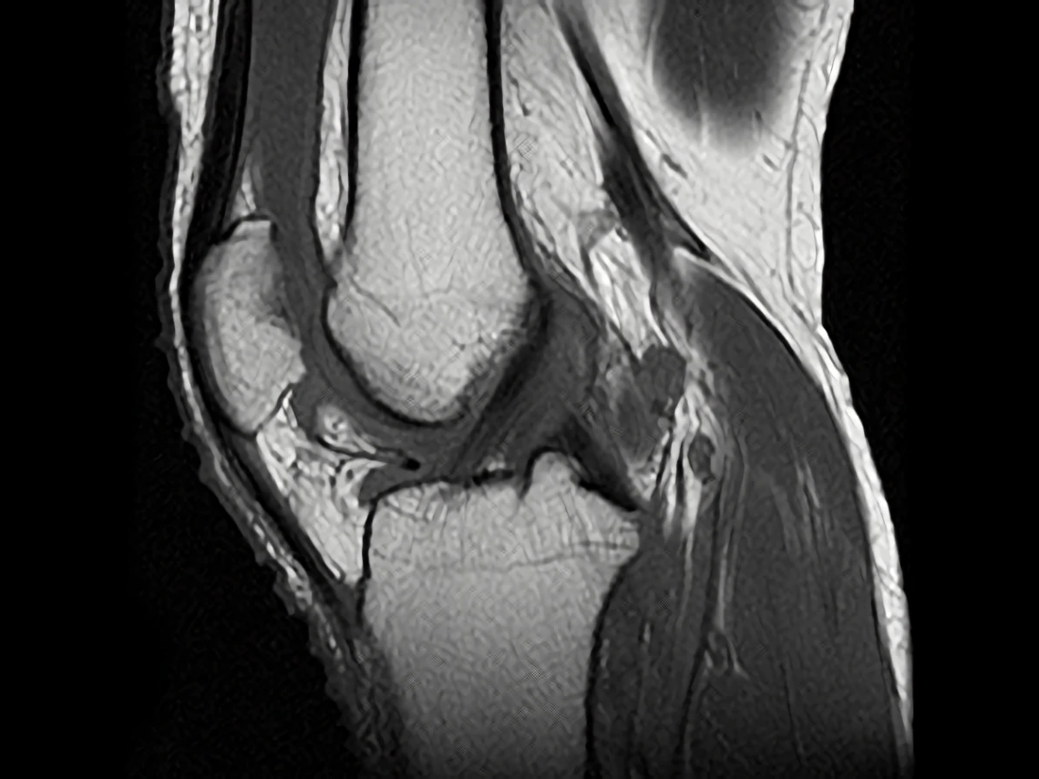 psoriatic arthritis knee xray